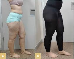 LIPHYRA Lipedema Leggings